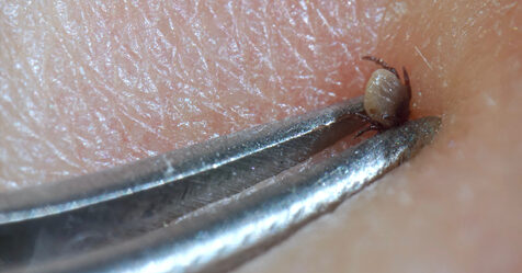 Lyme Disease Cases Increase in Warmer, Humid World