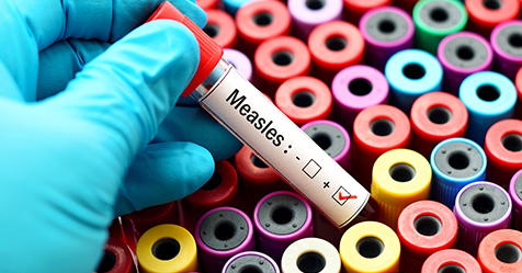 Blood test tube with measles results