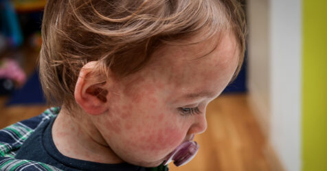 child with measles