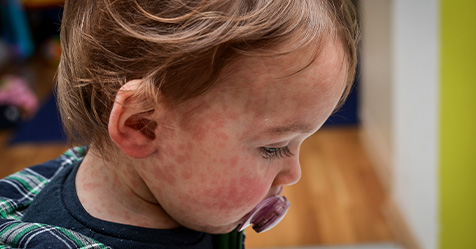 child with measles