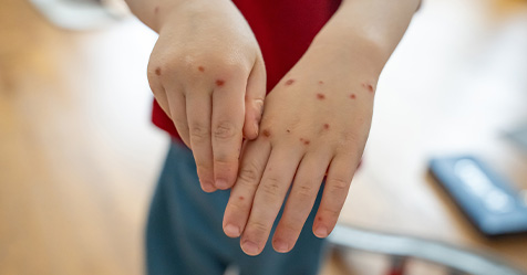 hand, foot, and mouth disease